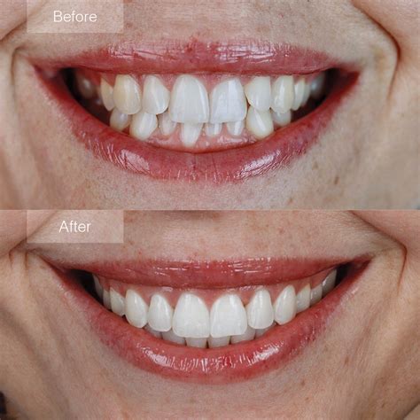 invisalign valbonne|Invisalign before and after .